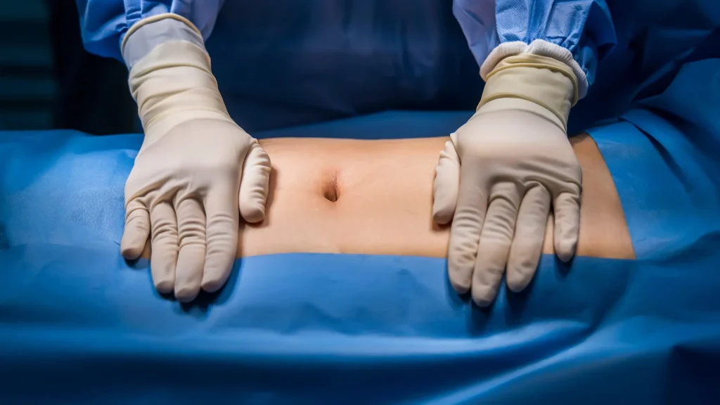 Surgeon prepares stomach for ALIF surgery incision