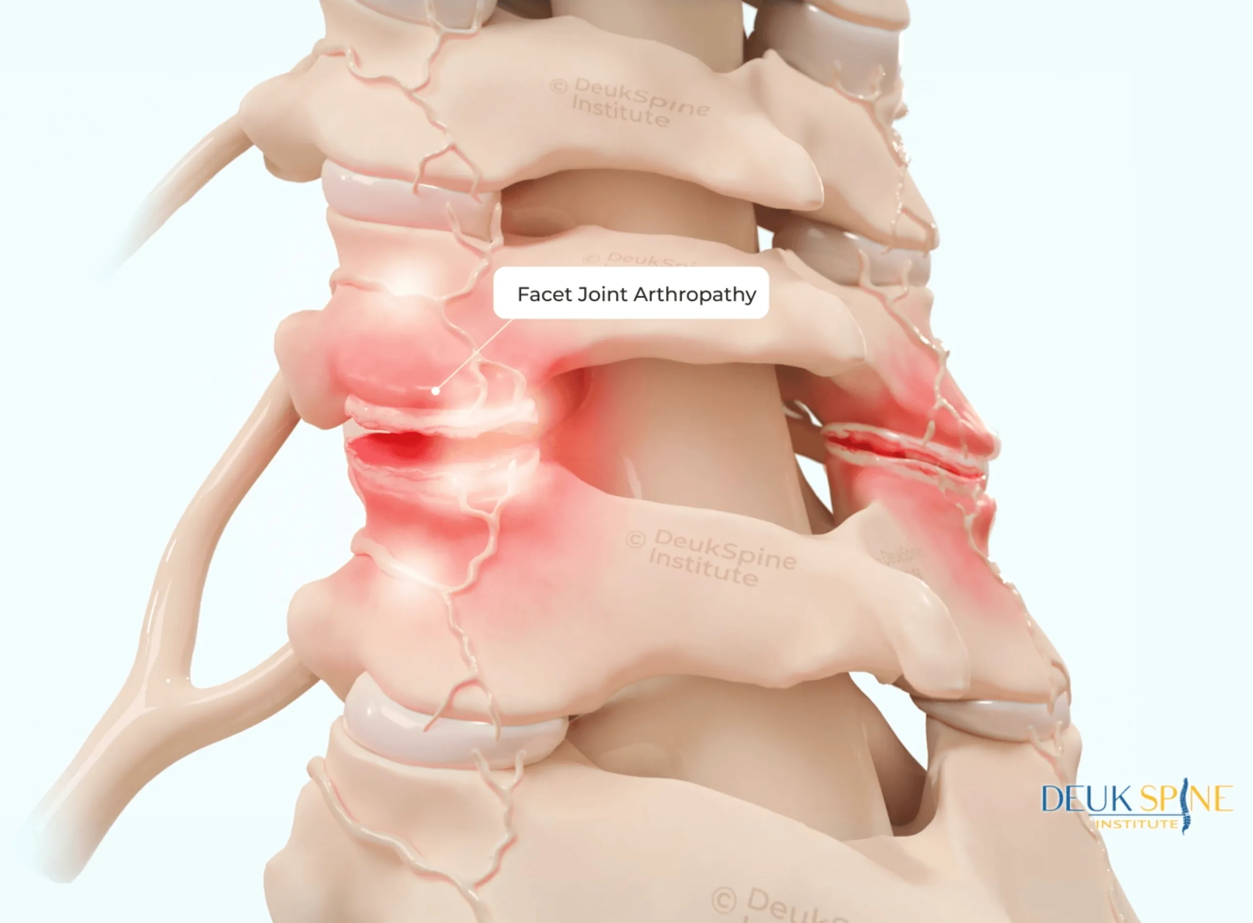 #5 Facet Joint Arthropathy.png
