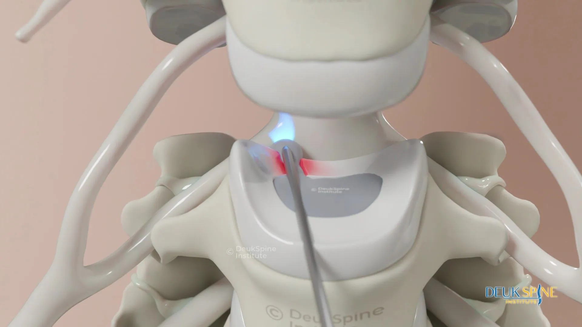 A picture demonstrating Deuk Laser Disc Repair performed on the cervical spine.