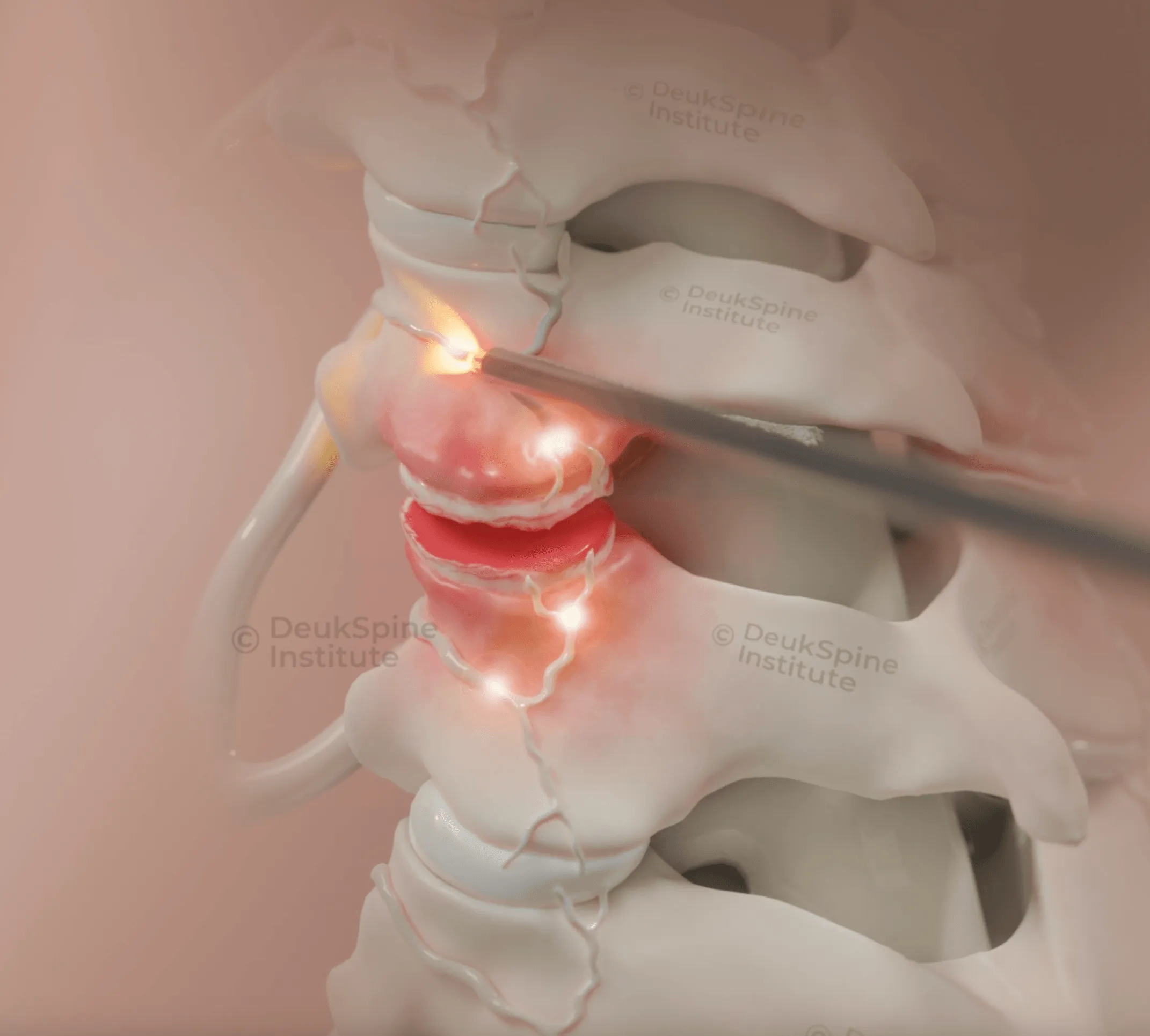 Animation showcasing deuk plasma wond burning the nerves completely to cure pain.