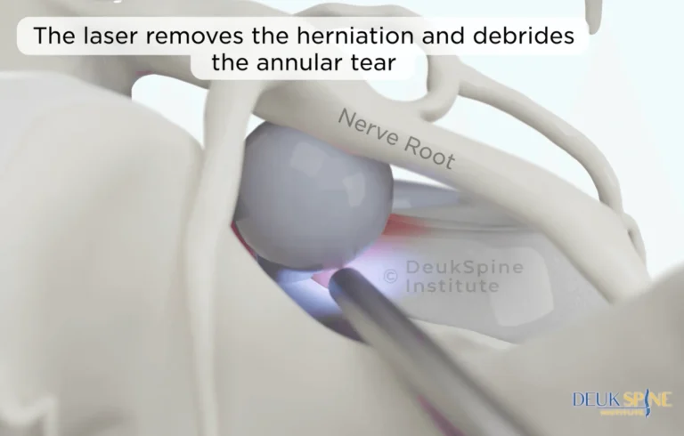 DLDR® Lumbar laser removing the herniation and the debridement of the annular tear - 3D.png