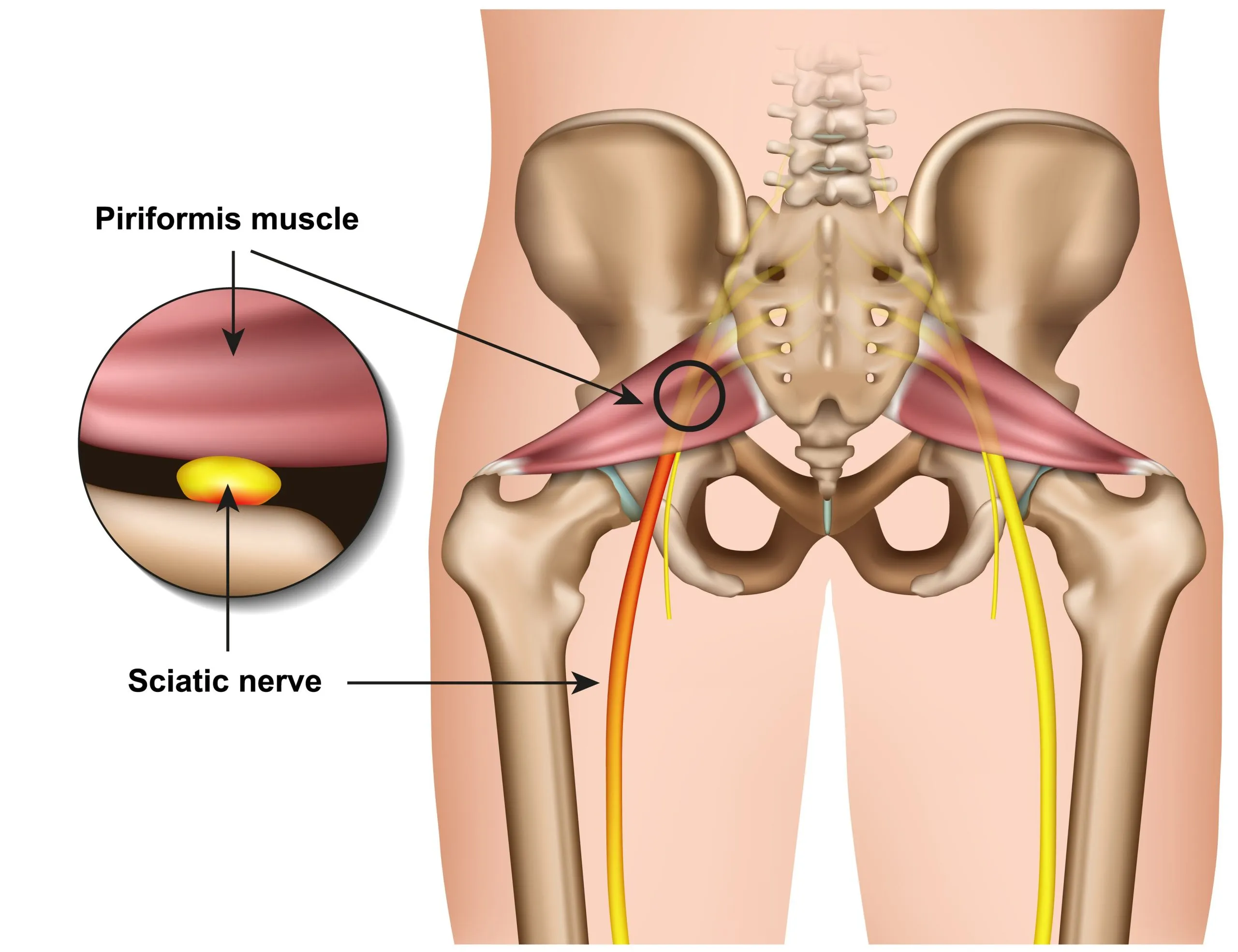 piriformis-syndrome.jpg