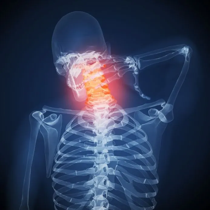 X-ray image showing a herniated disc at C4-C5 in the neck, highlighted in red.