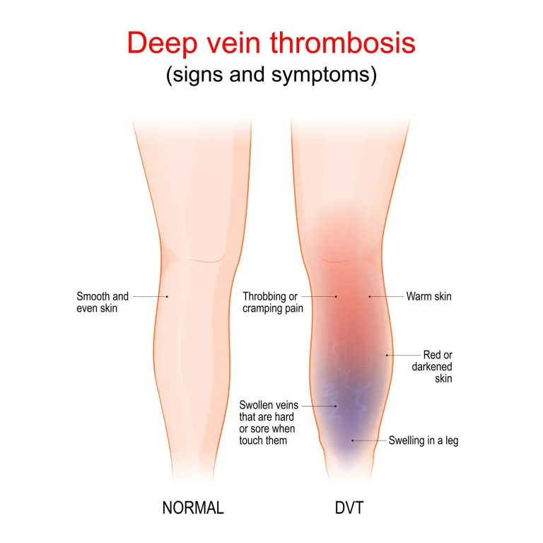 Illustration comparing normal leg to one with deep vein thrombosis symptoms like swelling and redness.