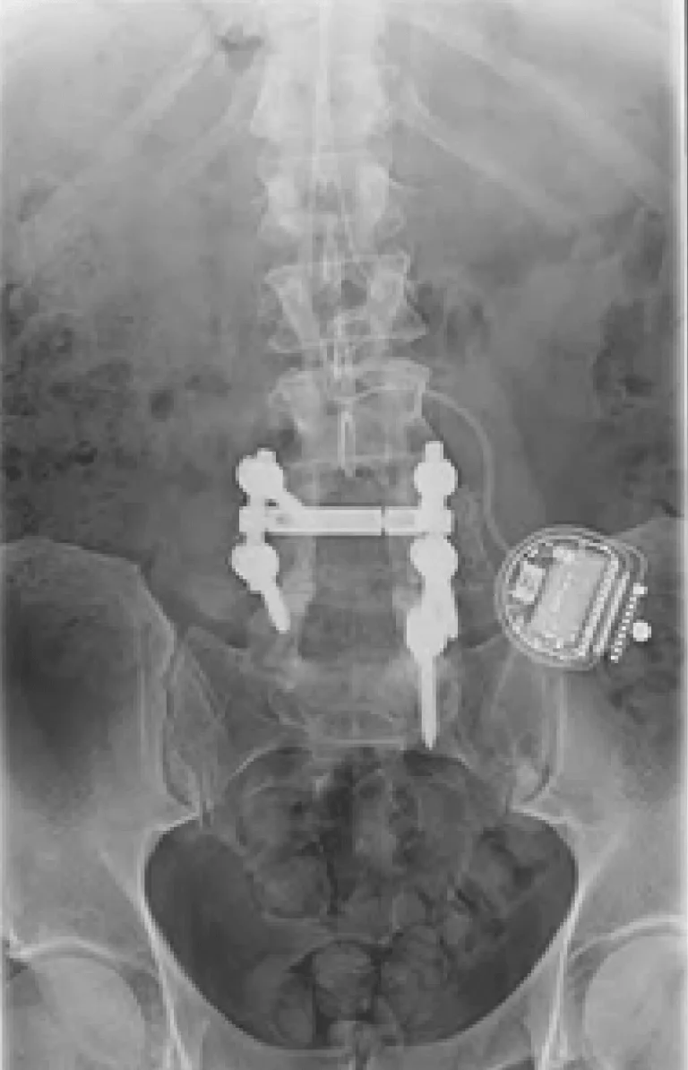 X-ray of a lower spine with metal implants and a medical device on the right side.