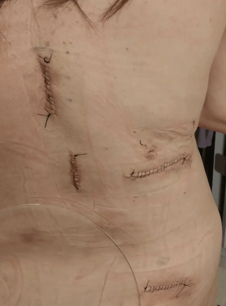 A person's side with multiple sutured surgical incisions.