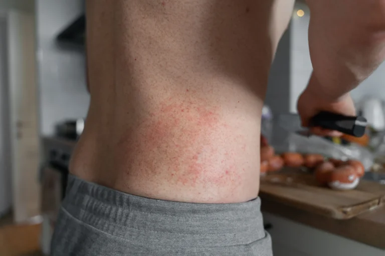 Person in gray shorts with a red rash on their lower back in a kitchen setting.
