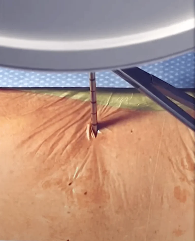 Close-up of a needle piercing skin under a circular medical instrument.