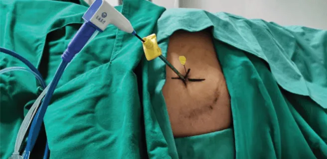 Surgical tools are positioned near a covered patient with an incision on the abdomen.