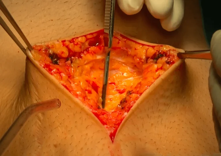 Surgical view of an abdominal incision being held open with forceps.
