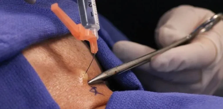 A medical professional injects a substance into a patient's skin using a syringe and clamp.