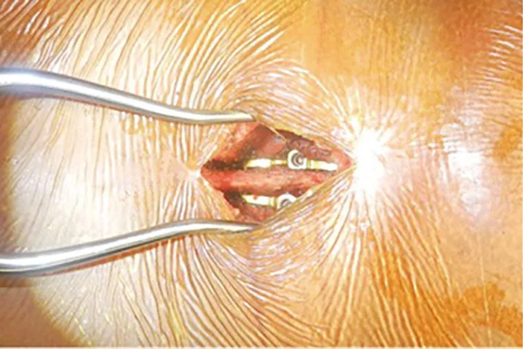 Surgical incision with retractors exposing internal hardware.