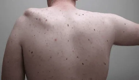 A person's back with multiple moles scattered across the skin.