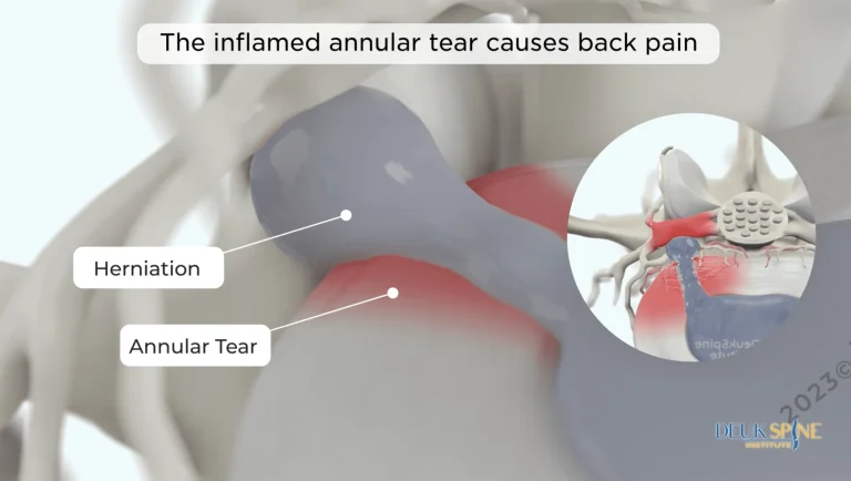 Illustration of an inflamed annular tear and herniation causing back pain.