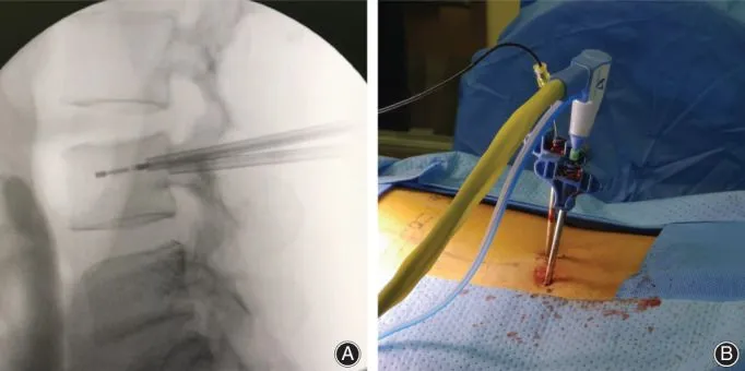 X-ray of spine with needles and surgical setup on patient's back.