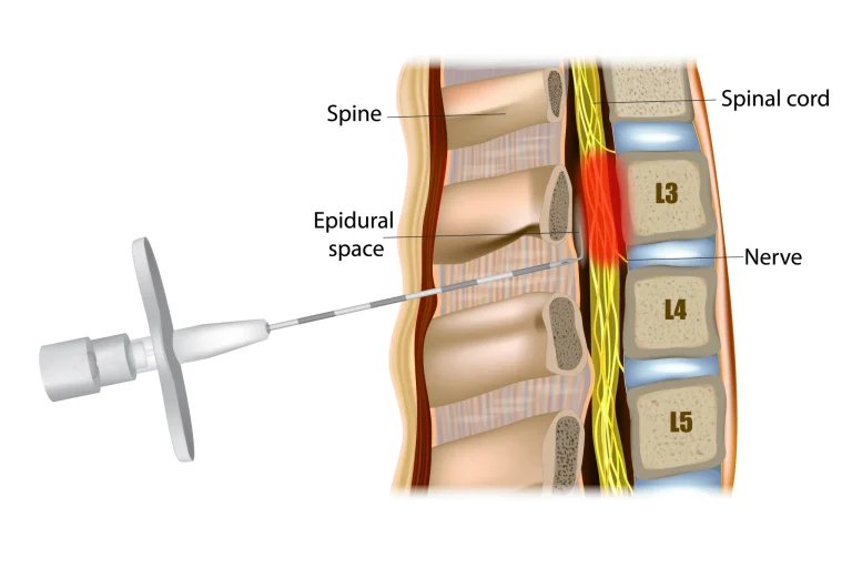 Diagram of an epidural injection into the spinal column, showing needle placement in the epidural space.