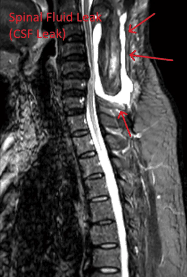 MRI image showing a spinal fluid leak with red arrows and text indicating the leak location.