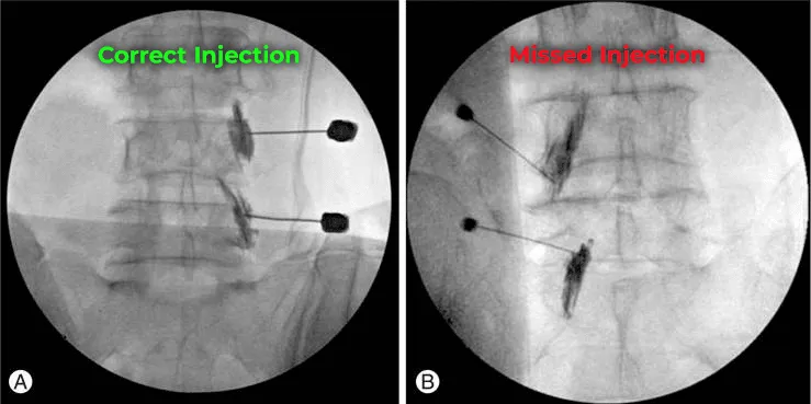 X-ray images showing correct and missed spinal injections labeled in green and red.