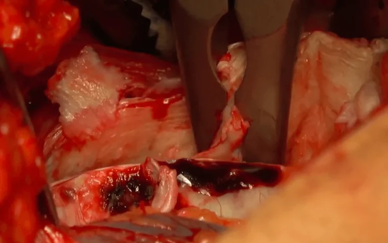 Surgical procedure showing close-up of bone cutting with a saw.