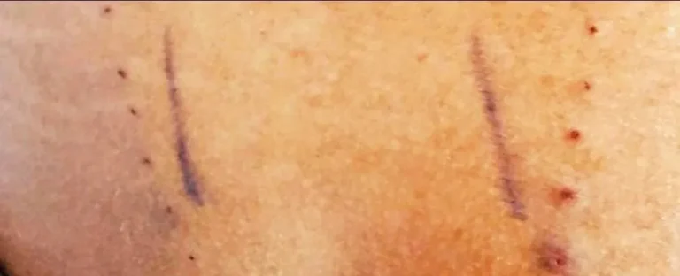 Close-up of skin with two vertical scars and several small red marks.