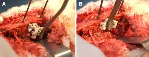 Surgical procedure showing spinal implant placement in an open incision.