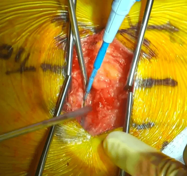 Surgical procedure with instruments and gloved hands on exposed tissue.