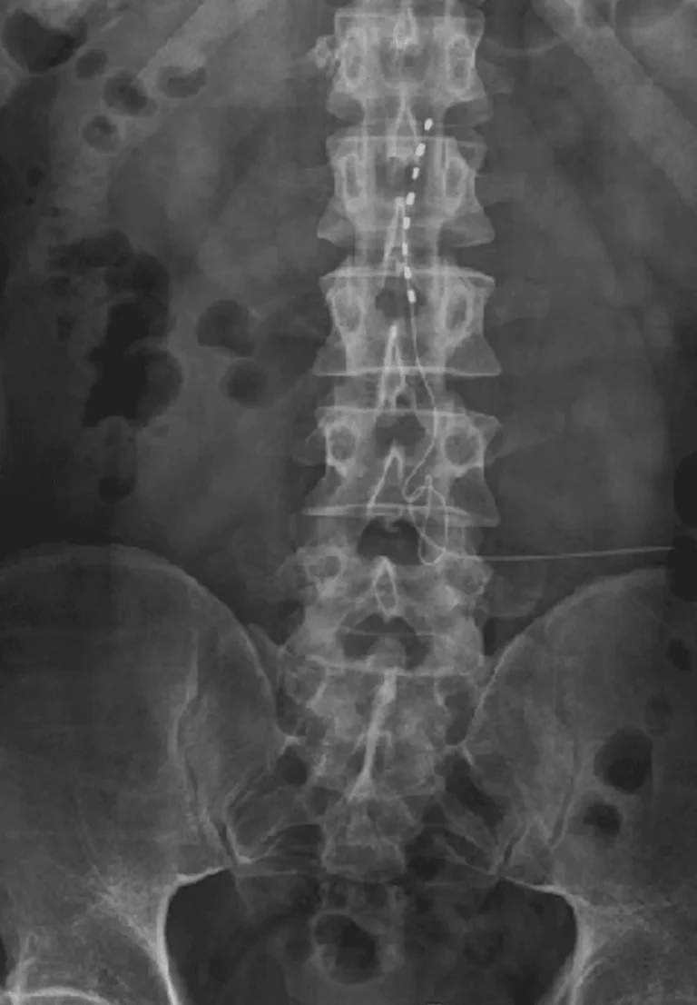 X-ray image showing a spinal column with a spinal cord stimulator implant.