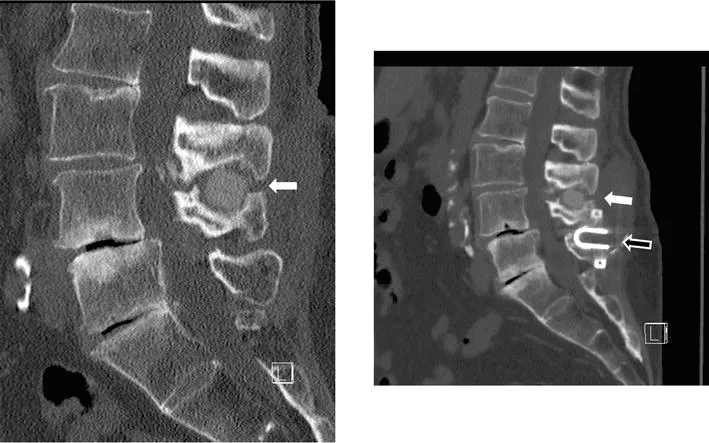 Two spinal CT scans with arrows indicating areas of concern on vertebrae.