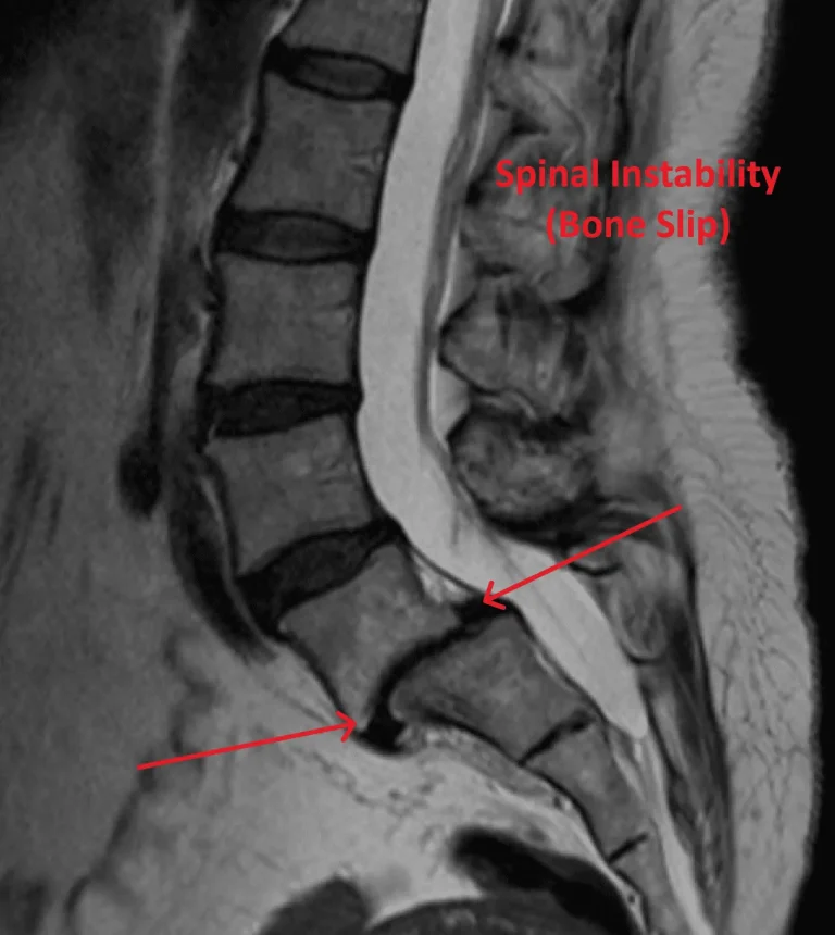 MRI scan showing spinal instability with bone slip, highlighted by arrows and labeled in red text.