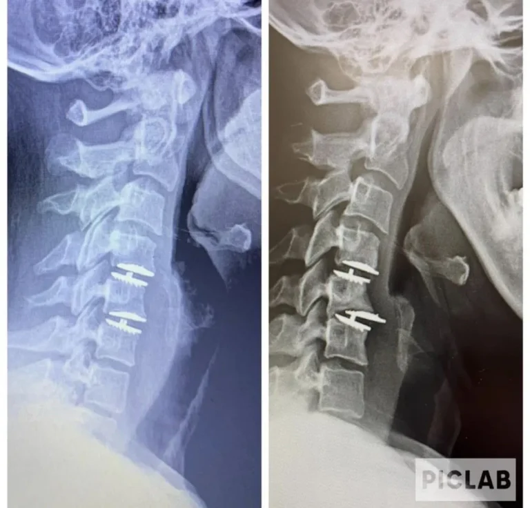 Side-by-side cervical spine X-rays with surgical screws visible.