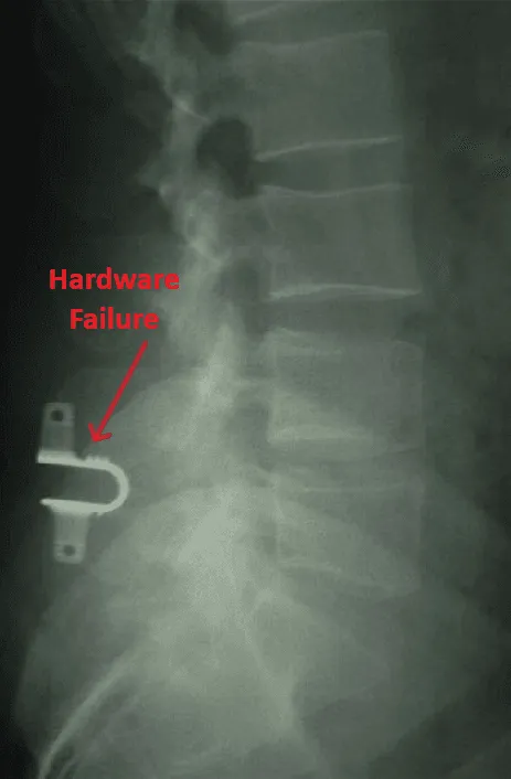 X-ray of a spine showing metal hardware labeled as failing.