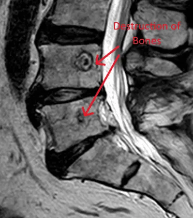 MRI image showing spinal bone destruction, highlighted by red arrows and text.