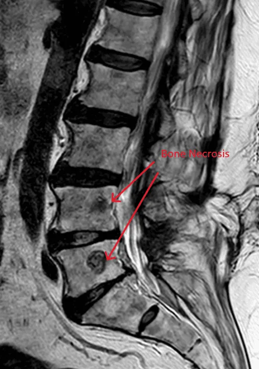 MRI of the lower spine highlighting bone necrosis with red arrows.