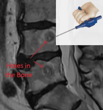MRI of spinal vertebrae with labeled bone holes and a tool illustration in the top right corner.
