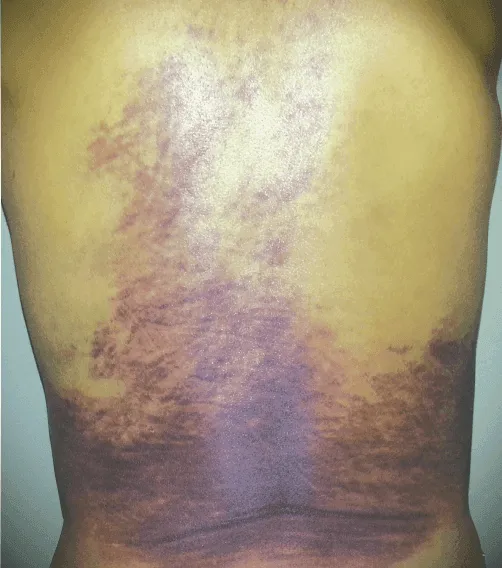 Large bruise on a person's back with purple and yellow discoloration.