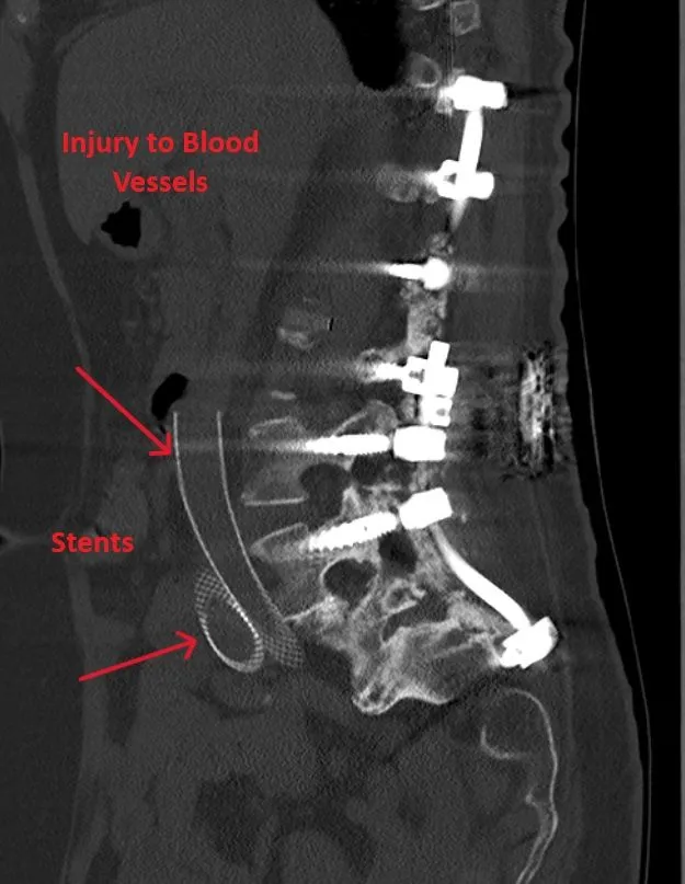 CT scan showing spinal hardware and labeled injury to blood vessels with stents.