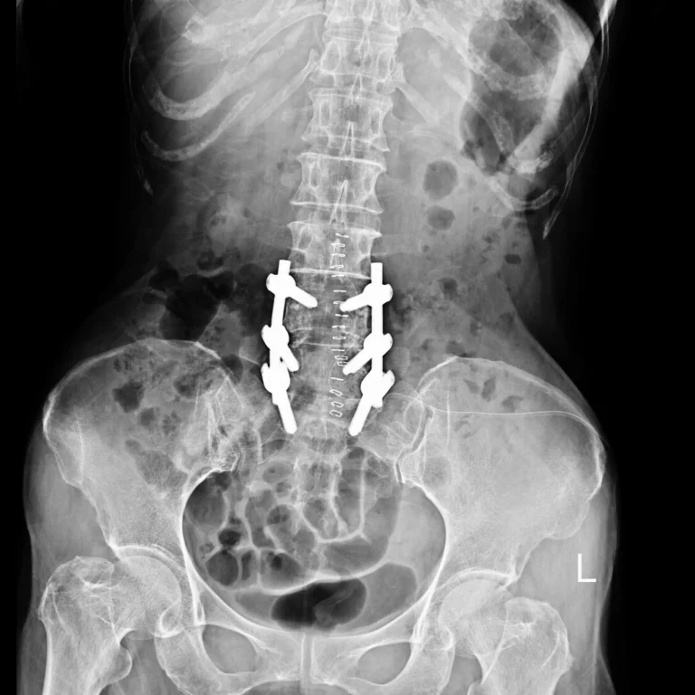 X-ray showing spinal fixation hardware in the lower back.