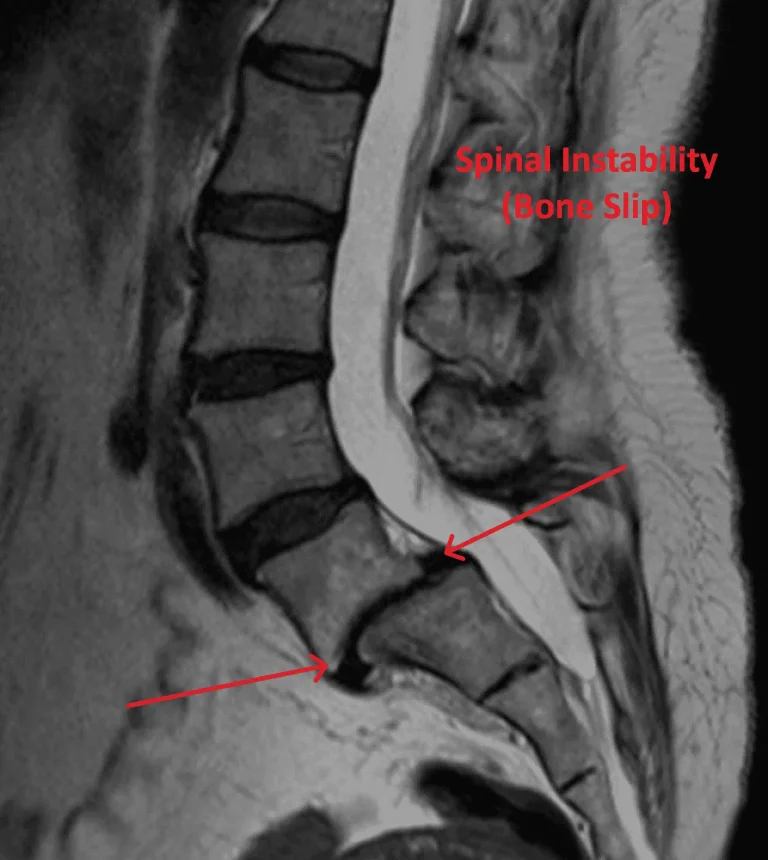 MRI showing spinal instability with highlighted bone slip.