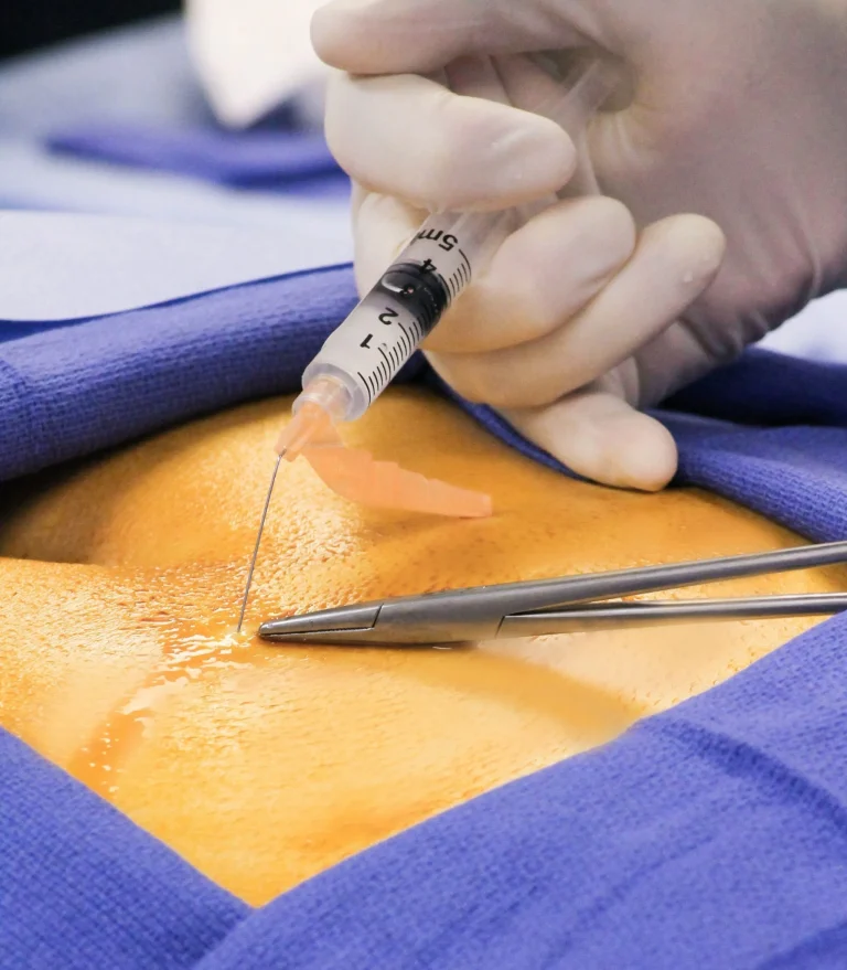 Gloved hands using a syringe and forceps on skin prepared for a medical procedure.