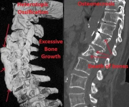 Comparison of spinal CT scans showing heterotopic ossification and osteonecrosis with labeled annotations.