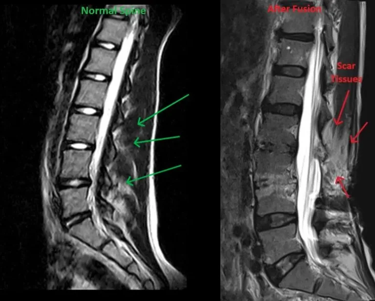 Side-by-side MRI scans showing a normal spine and a spine after fusion with scar tissues.