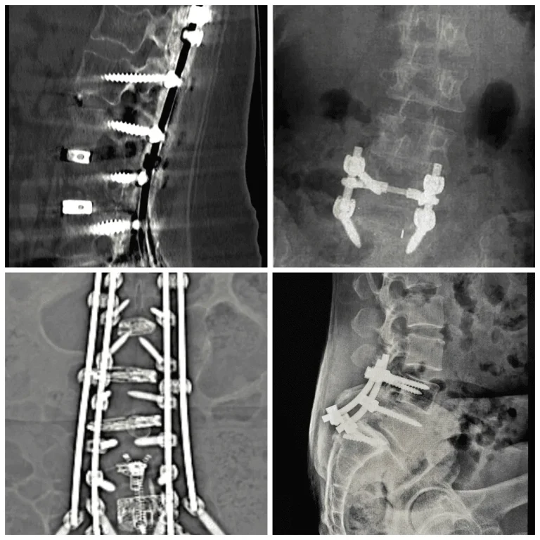 X-ray images showing spinal surgeries with metal implants and screws.