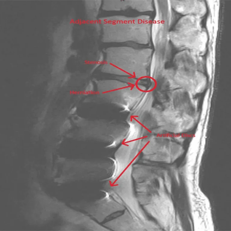 MRI image showing adjacent segment disease with labeled stenosis, herniation, and artificial discs.