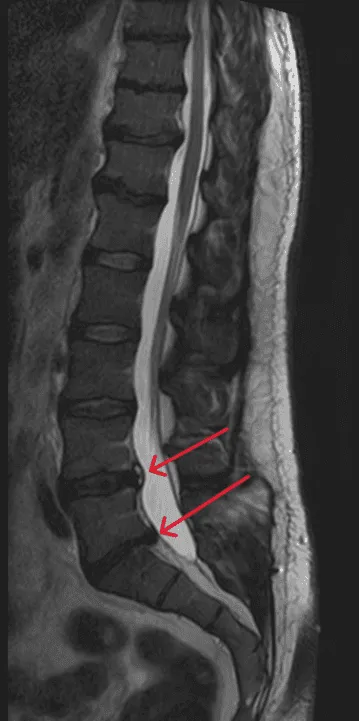 MRI scan of the lower spine with two red arrows pointing to specific areas.