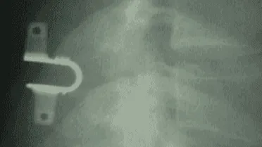 X-ray showing a spinal column with a metal surgical bracket attached.