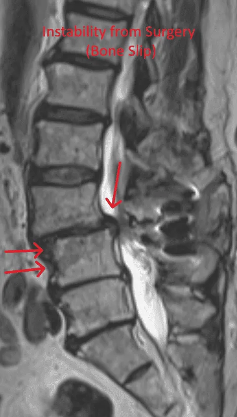 MRI of the spine showing bone slip due to post-surgical instability, indicated by red arrows.