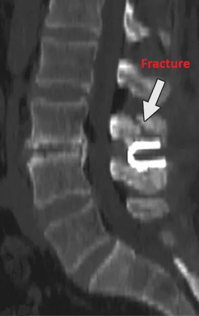 CT scan showing a spinal fracture labeled with an arrow.