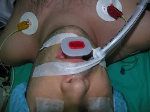 Person lying down with medical tubing and electrodes attached to the chest, eyes covered with tape.