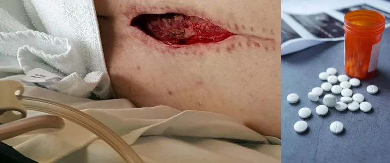 A surgical wound on skin and scattered white pills near an open orange bottle.