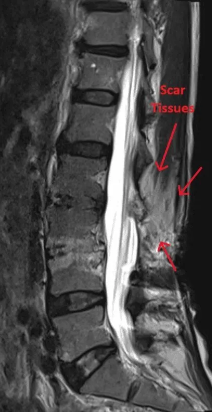 MRI scan of a spine showing scar tissues marked with red arrows.